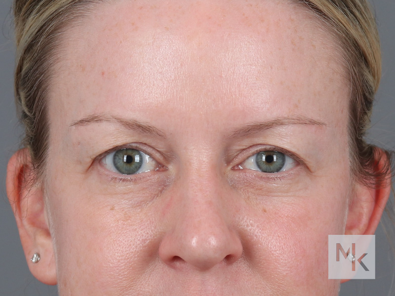 Upper Blepharoplasty Before and After | Dr. Michael Kim