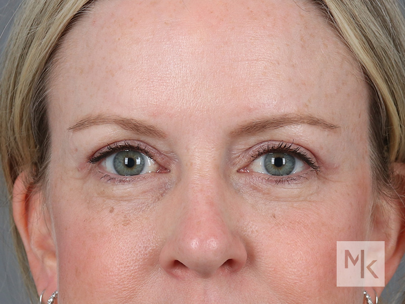 Upper Blepharoplasty Before and After | Dr. Michael Kim