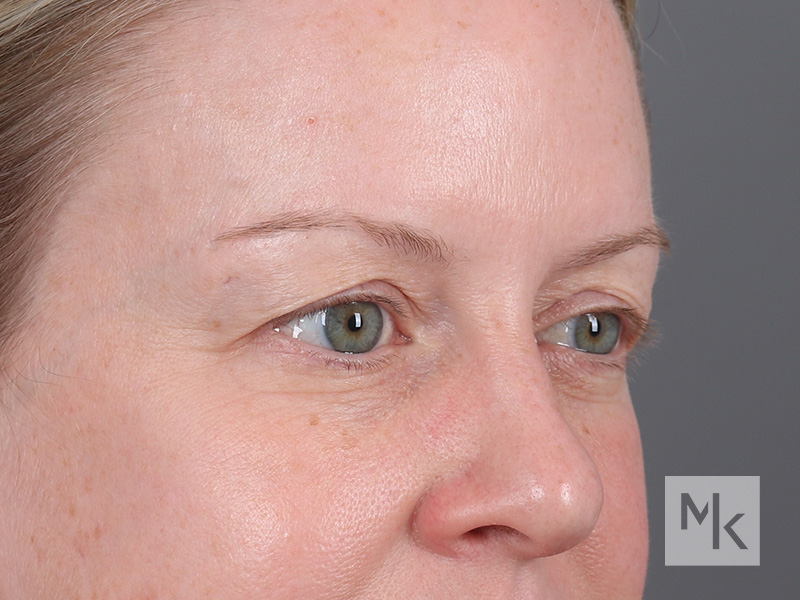 Upper Blepharoplasty Before and After | Dr. Michael Kim