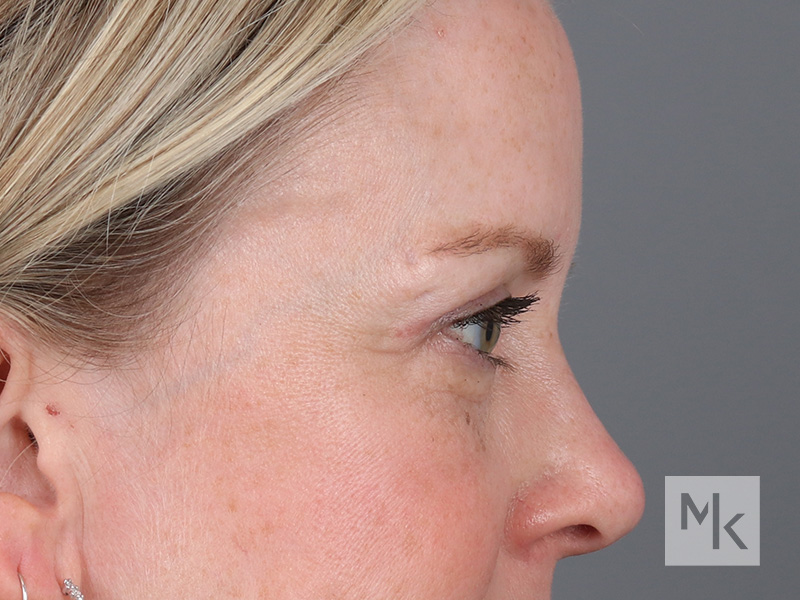 Upper Blepharoplasty Before and After | Dr. Michael Kim