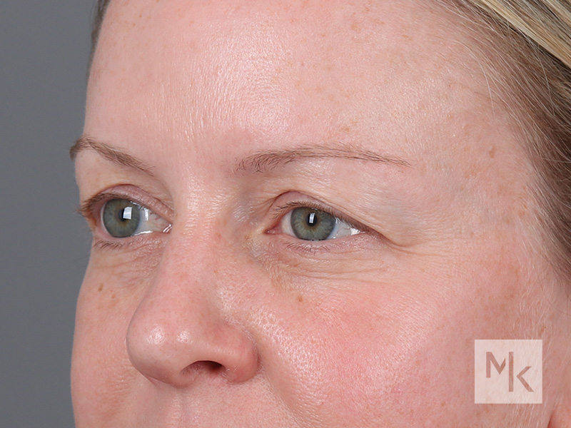 Upper Blepharoplasty Before and After | Dr. Michael Kim