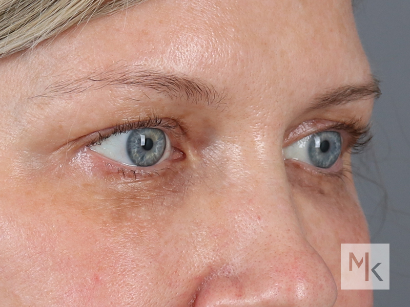 Upper Blepharoplasty Before and After | Dr. Michael Kim