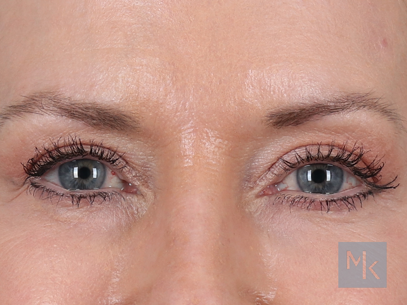 Upper Blepharoplasty Before and After | Dr. Michael Kim